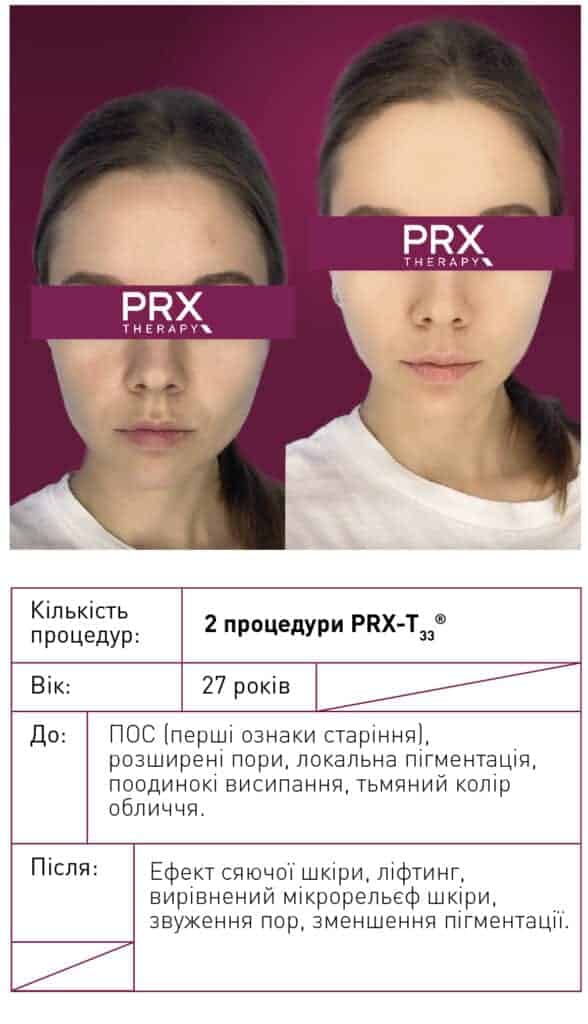 фото до і після prx-t33