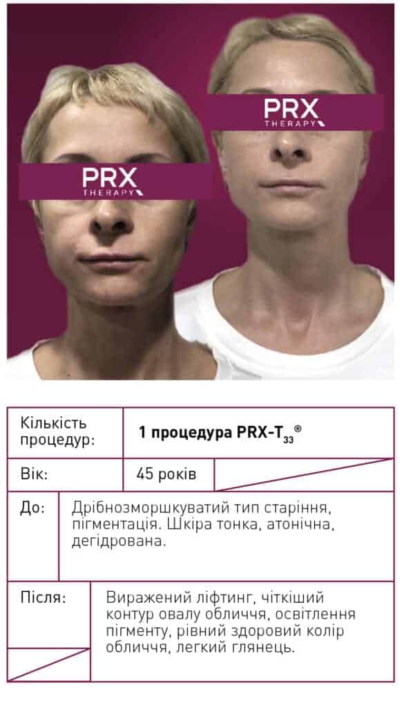 фото до после prx-t33